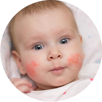 Atopowe zapalenie skóry u niemowląt - przyczyny choroby