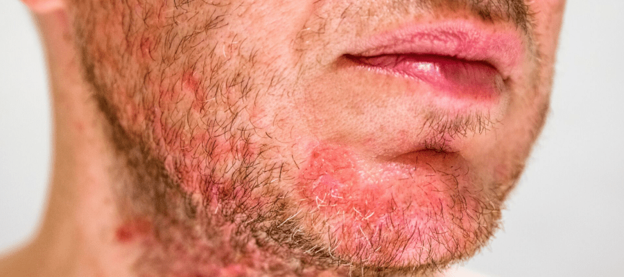 Atopowe zapalenie skóry twarzy – na co zwrócić uwagę