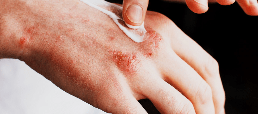 Atopowe zapalenie skóry leczenie