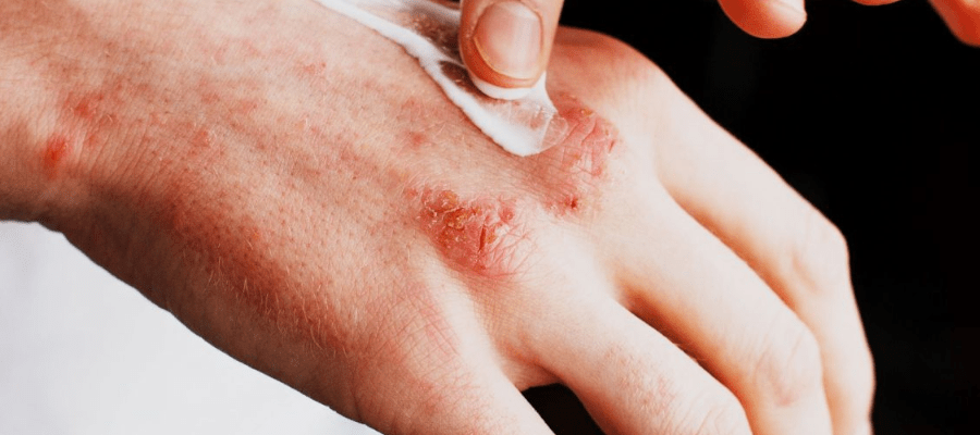 Atopowe zapalenie skóry - leczenie domowe