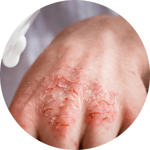 Atopowe zapalenie skóry - leczenie domowe