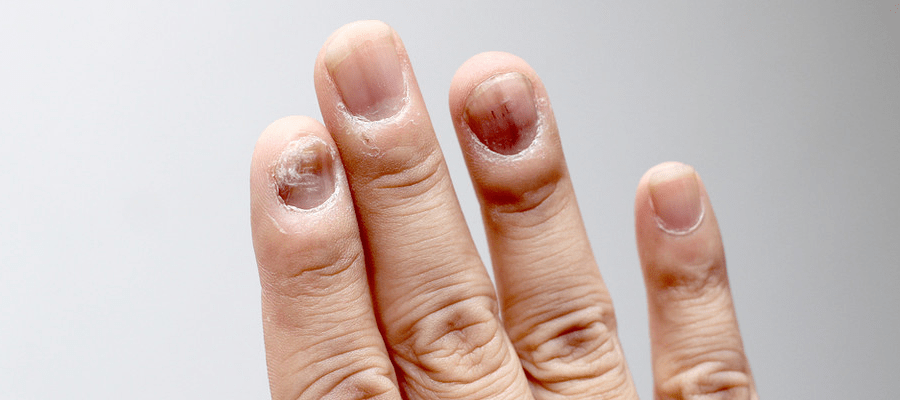 Łamliwe paznokcie