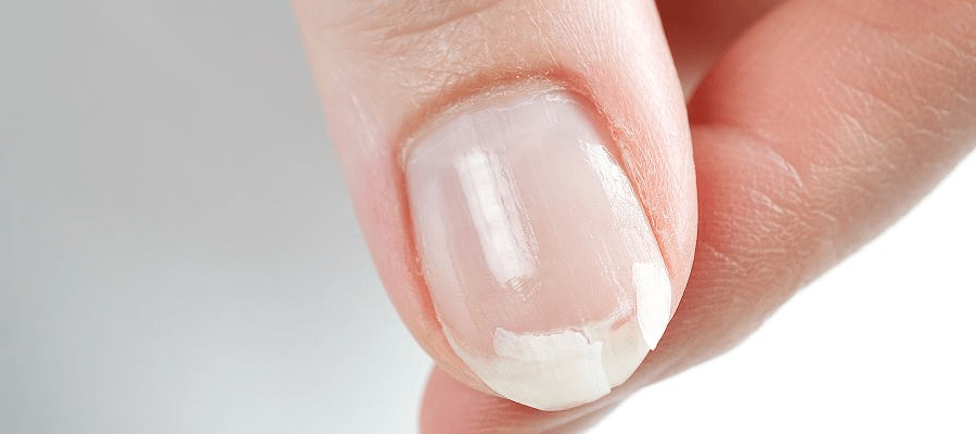 Rozdwajające się paznokcie - przyczyny problemu